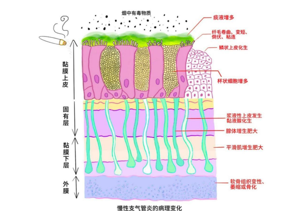 纤毛细胞带你看“慢支”