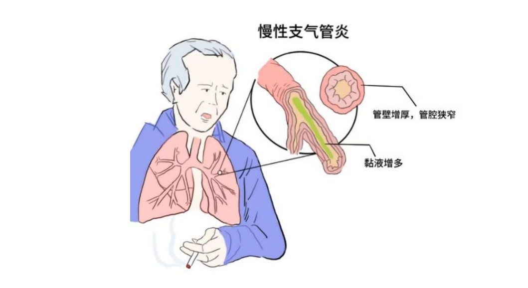 纤毛细胞带你看“慢支”