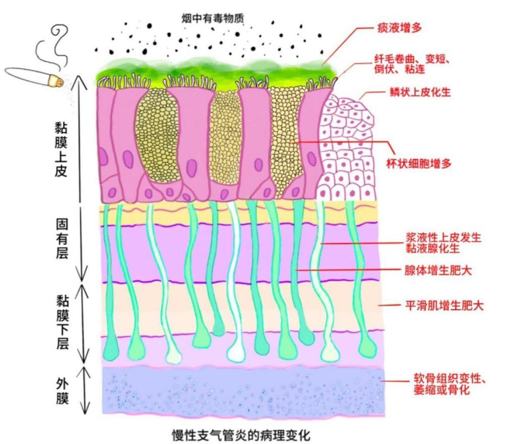 纤毛细胞带你看“慢支”