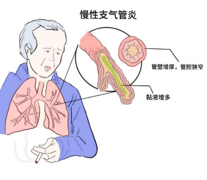 纤毛细胞带你看“慢支”