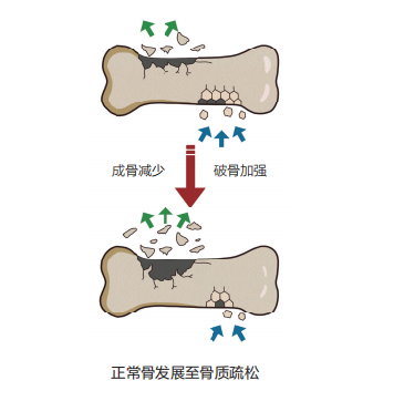 骨质疏松症不是“老年病”！除了补钙、晒太阳，专家还推荐这些方法……